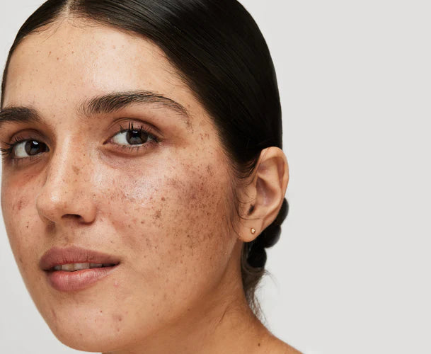 Melanofacial Package