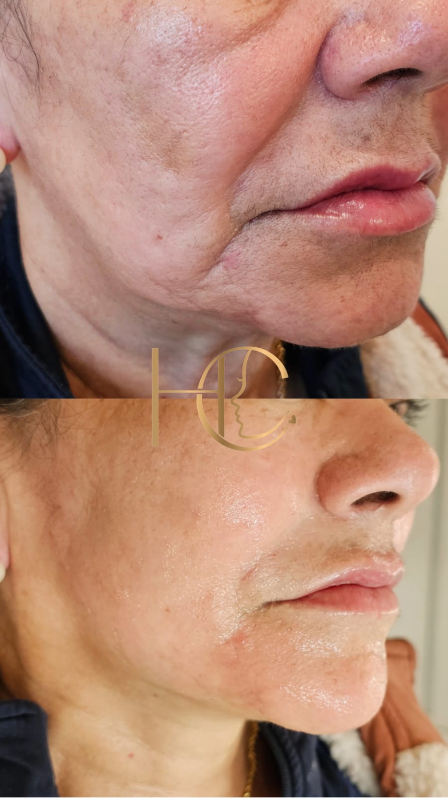 Facelift Protocol