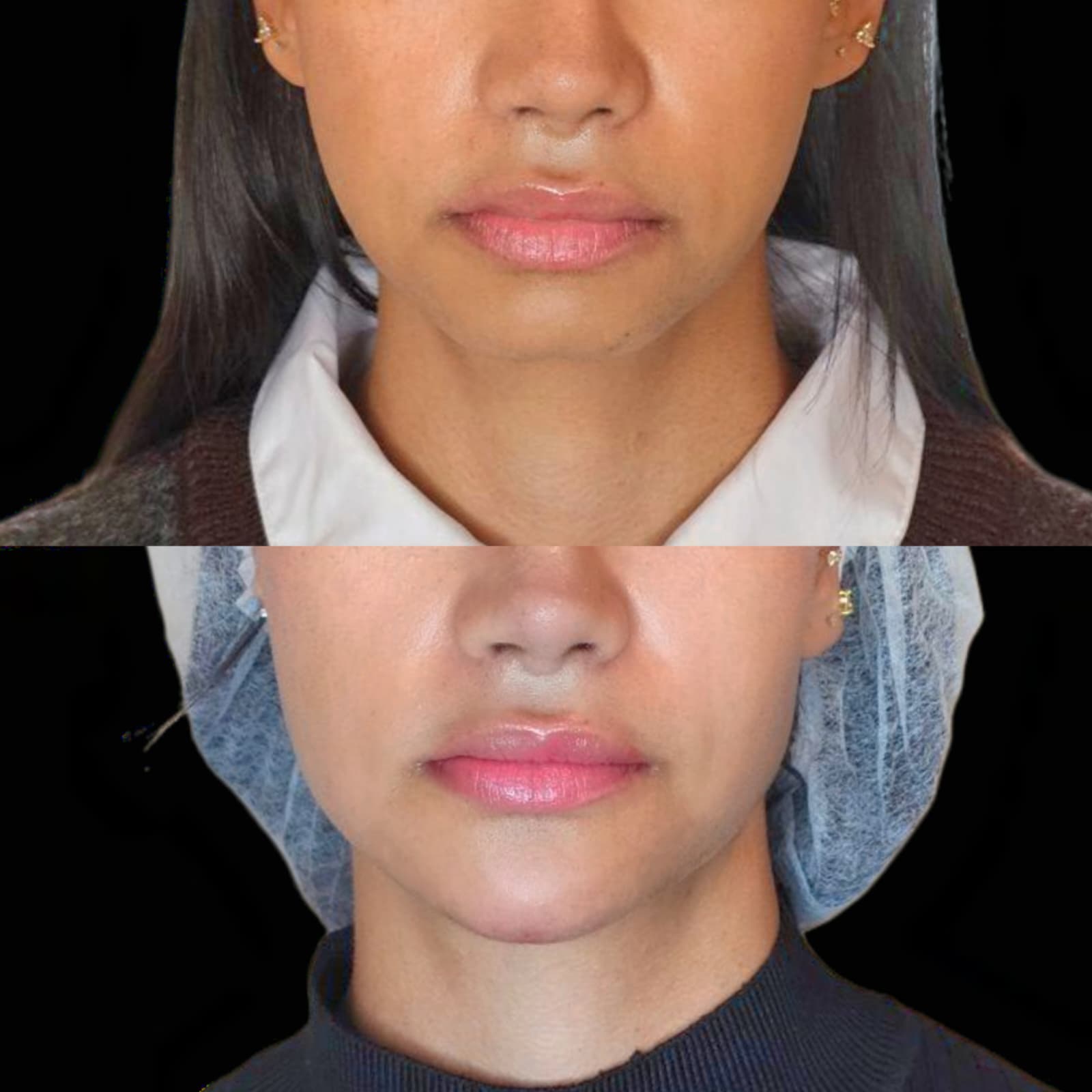 Chin Augmentation with Hyaluronic Acid Dermal Filler