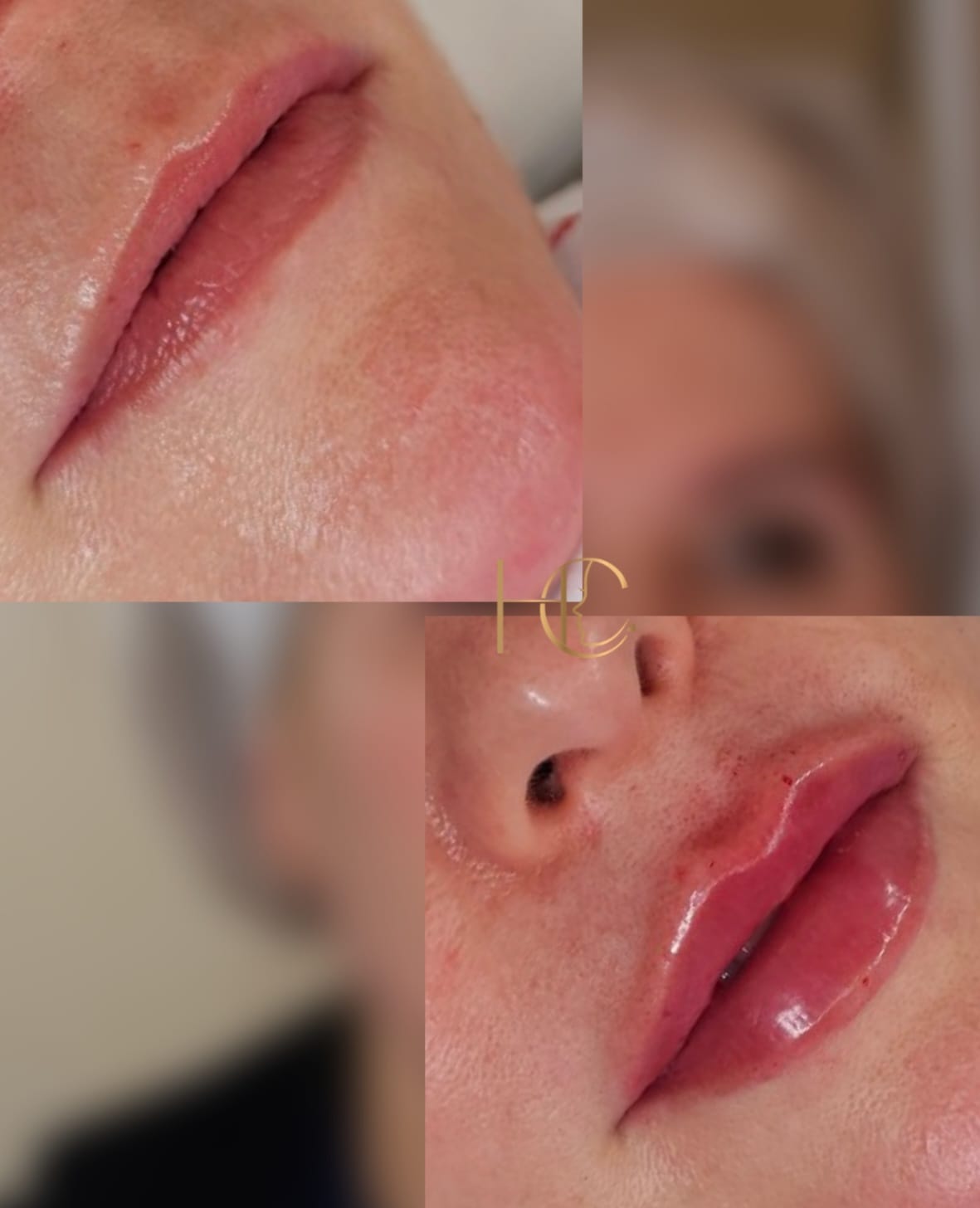 Lip Filler 1ml