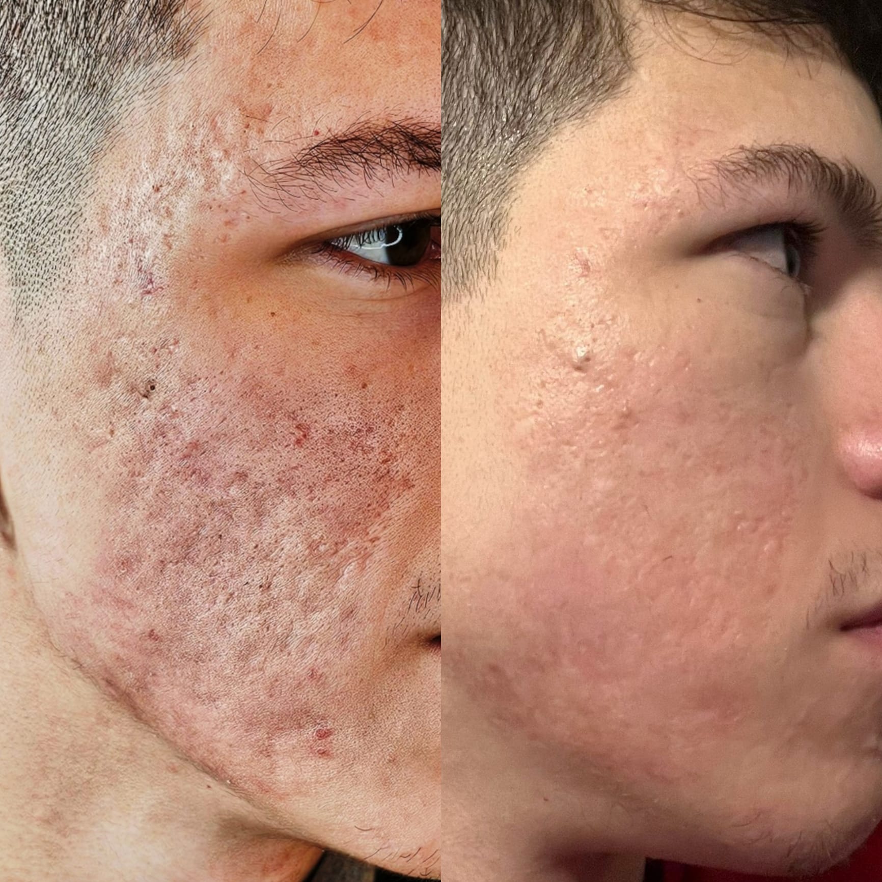 Facial Acne Scar Treatment (per session)